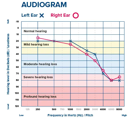 Audiogram example
