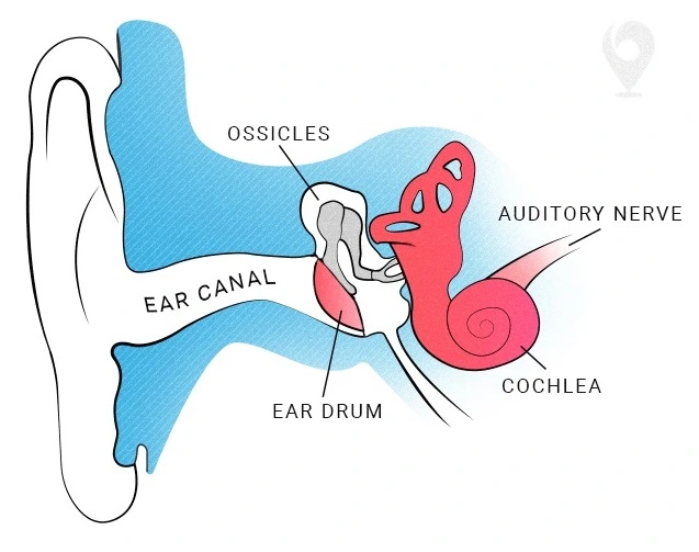 Audiogram hearing test chart showing sensorineural hearing loss pattern
