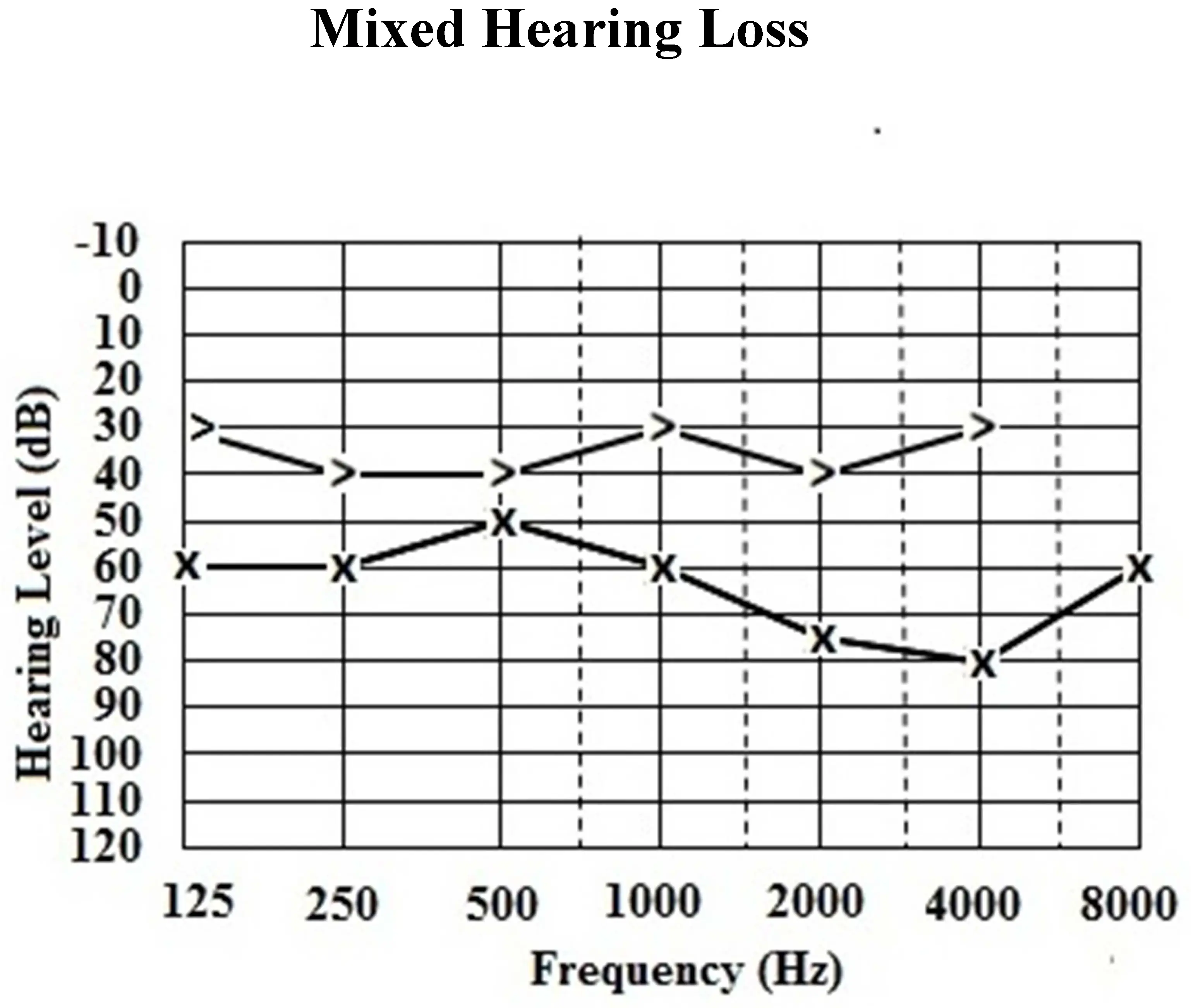 Mixed hearing loss diagram showing conductive and sensorineural hearing damage